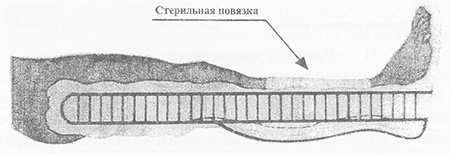 Первая помощь при открытом переломе