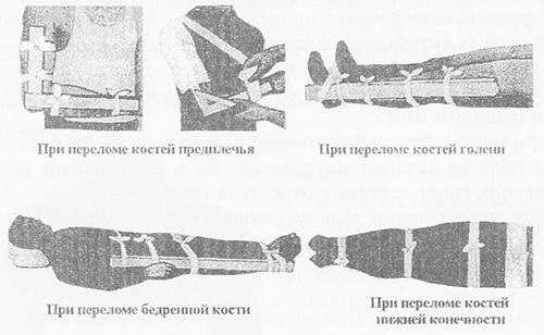 Иммобилизация конечностей подручными средствами