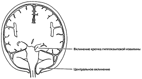 Виды вклинения головного мозга