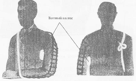 Иммобилизация шиной Крамера при переломах плечевой кости
