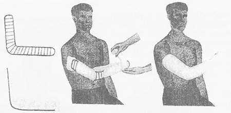 Иммобилизация шиной Крамера при переломах костей предплечья